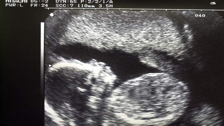 ultrasound scan of baby