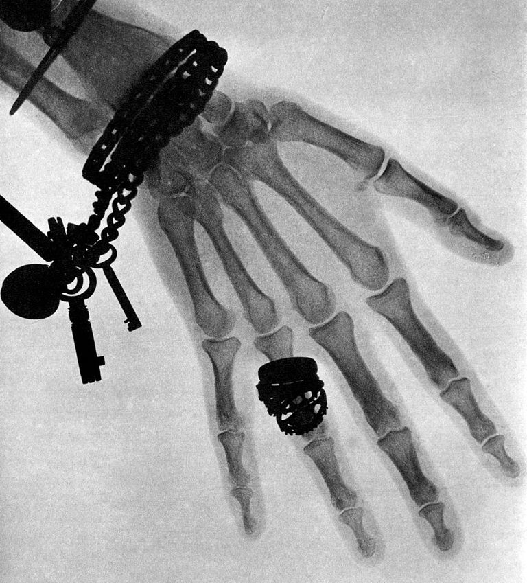https://www.gettyimages.com/detail/news-photo/this-is-one-of-the-first-x-ray-photographs-taken-in-the-uk-news-photo/588890779?phrase=x-ray%20&adppopup=true