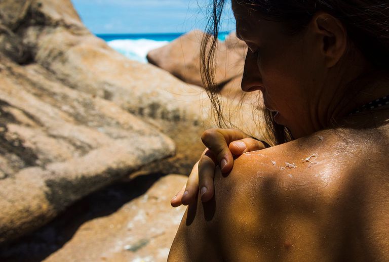 https://www.gettyimages.com/detail/news-photo/woman-has-a-sunburn-at-her-back-skin-at-anse-petite-on-news-photo/490385722