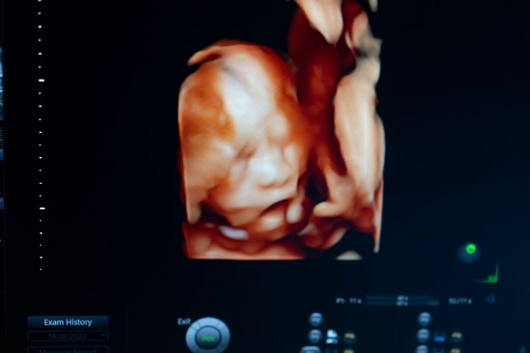 https://www.gettyimages.co.uk/detail/photo/doctor-used-an-ultrasound-3d-sonogram-monitor-for-royalty-free-image/1434364223?phrase=twin+embryo&adppopup=true