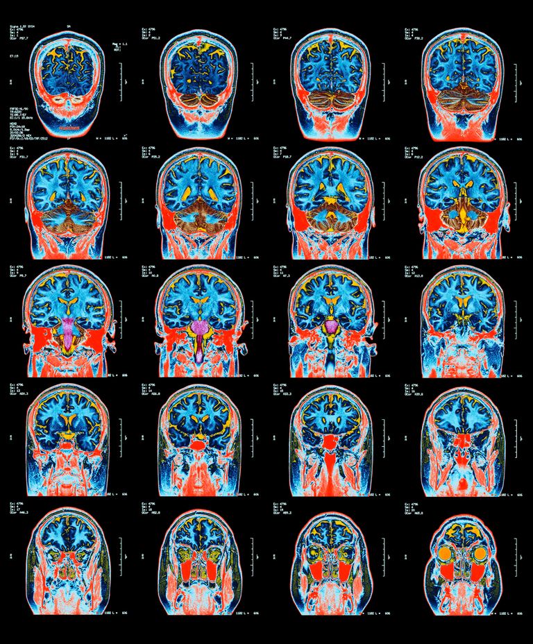 https://www.gettyimages.co.uk/detail/illustration/scan-of-brain-royalty-free-illustration/85757551?phrase=brain+scan&adppopup=true