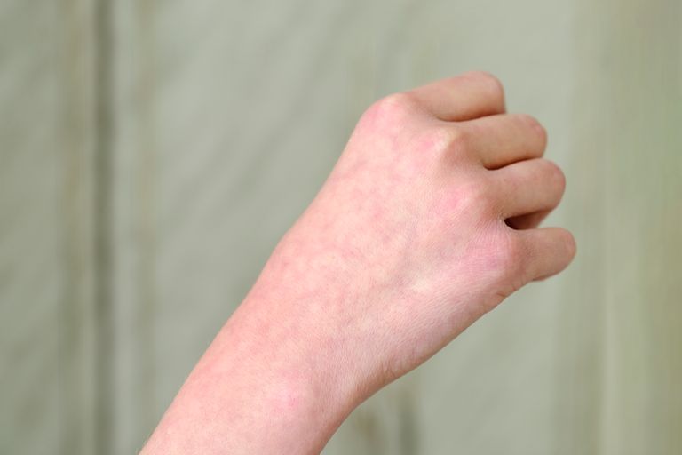 https://www.gettyimages.com/detail/photo/the-vascular-pattern-is-located-on-a-persons-arm-or-royalty-free-image/1343990936?phrase=sick+woman+purple+skin